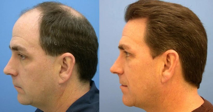 The Cost Of Hair Transplant Surgery