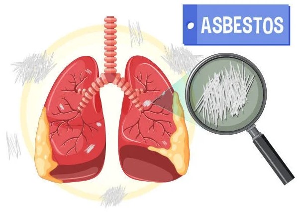 Asbestosis: Understanding the Risks and Prevention