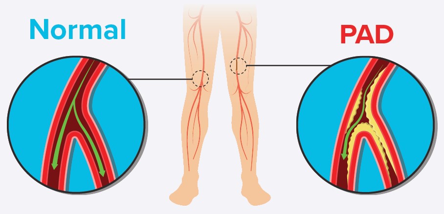 Atherosclerosis (Peripheral): Understanding, Preventing, and Managing This Silent Threat